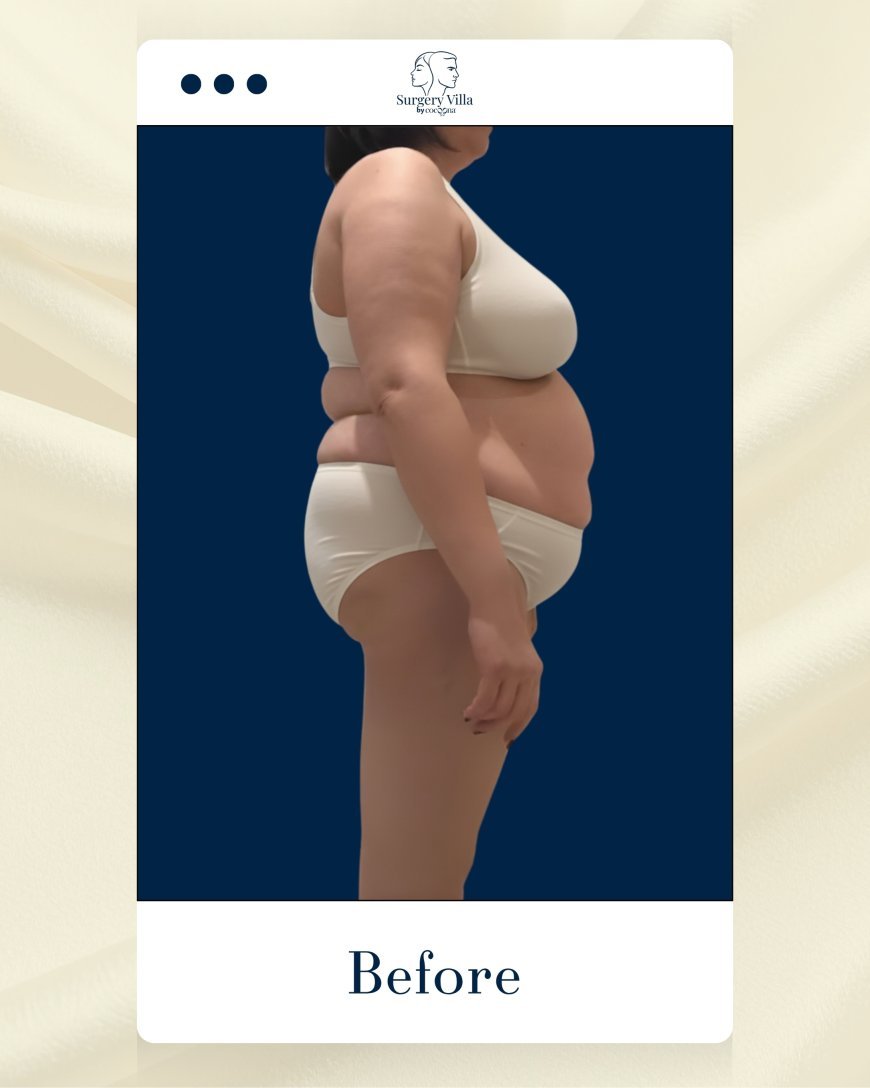 عملية شفط الدهون ونحت القوام للسيدات